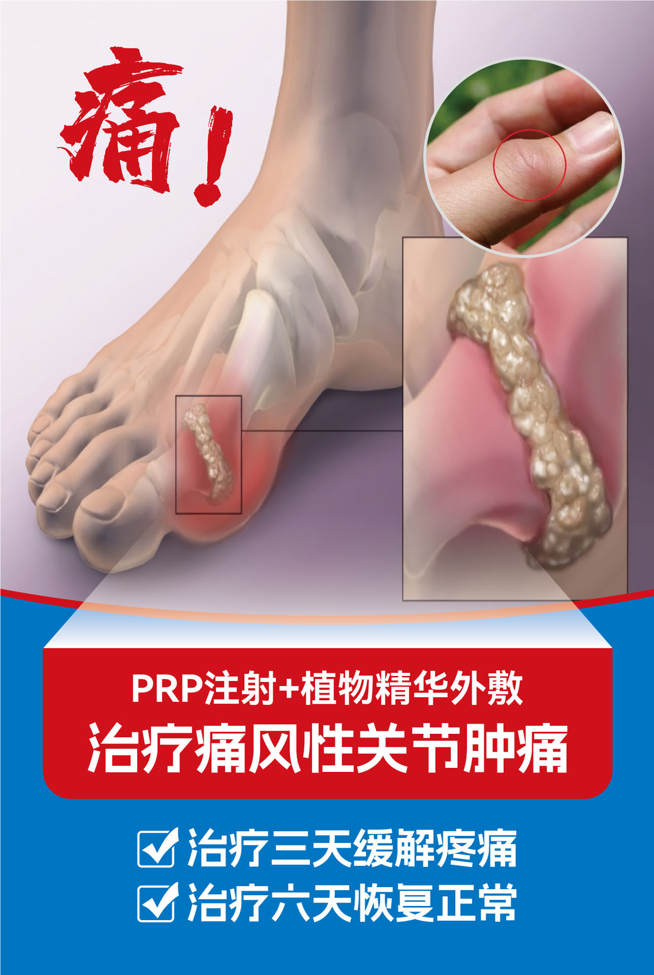 痛风性关节.jpg